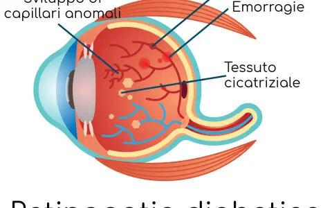 Illustrazione della retinopatia diabetica: sviluppo di capillari anomali, rigonfiamenti, emorragie retiniche che si riassorbono e tessuto cicatriziale.