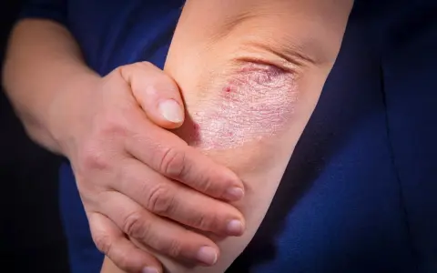 Psoriasis sur le coude, une affection cutanée rouge et squameuse. La main d'une personne touche doucement la zone affectée.