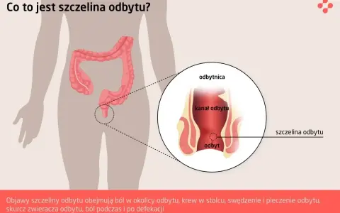 Ilustracja medyczna przedstawiająca szczelinę odbytu. Widoczny jest fragment jelita grubego i odbytnicy z zaznaczoną szczeliną.