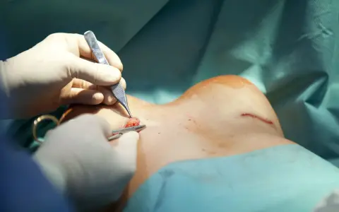 Ile trwa operacja powiększenia biustu? Zaskakujące fakty o czasie zabiegu