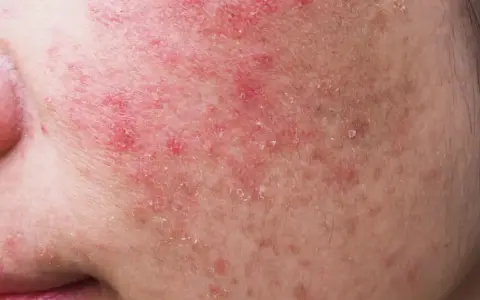 Gros plan sur une peau rougie et squameuse, signe d'une allergie cutanée au visage. Des plaques rouges et des petites pellicules sont visibles.