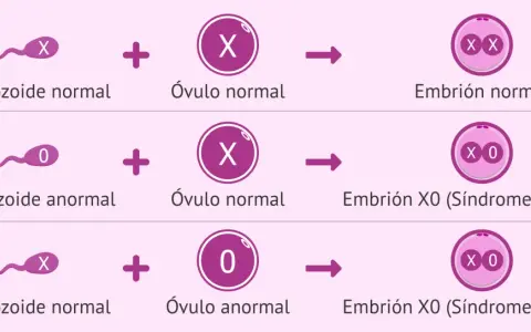 Ilustración de la monosomía X. Muestra cómo un espermatozoide anormal (0) o un óvulo anormal (0) pueden resultar en un embrión X0, conocido como Síndrome de Turner.