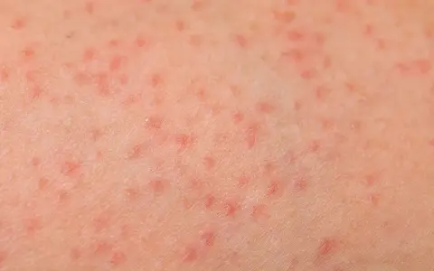 Pelle con prurito alle gambe, caratterizzata da numerosi puntini rossi che indicano un'irritazione cutanea.
