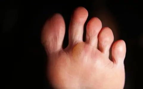 Gros plan sur un pied, montrant une phlyctène jaune entre deux orteils, signe d'une irritation due à la marche.