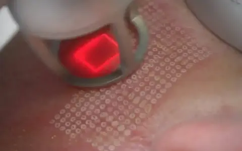 Zabieg laserem frakcyjnym: czerwony promień lasera tworzy na skórze siatkę mikrouszkodzeń. Czy laser frakcyjny boli? Odczucia są indywidualne.