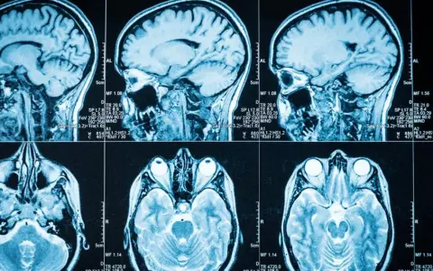 Guz mózgu objawy psychiczne: jak rozpoznać niebezpieczne sygnały