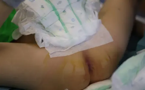 Niemowlę w pieluszce, które 3 latek sika 2 razy dziennie, leży na boku. Widoczne są ślady po wkłuciach.