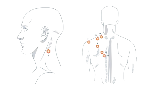 Illustration zeigt Triggerpunkte am Nacken und Rücken, die auf einen verspannten Trapezmuskel und dessen Ursache hinweisen.
