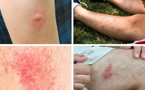 Plusieurs réactions cutanées, dont une piqure de moustique infectée, montrent une inflammation et des rougeurs sur la peau.
