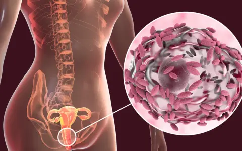Anatomía femenina con detalle ampliado de vaginosis bacteriana.
