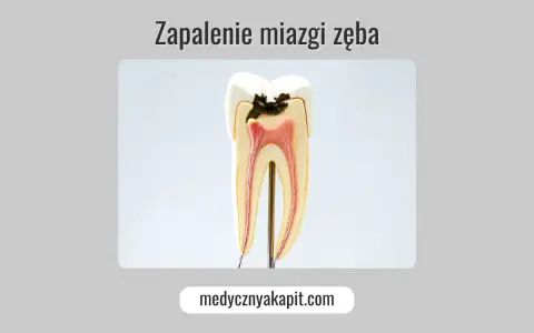 Model zęba z widocznym ubytkiem i zapaleniem miazgi.