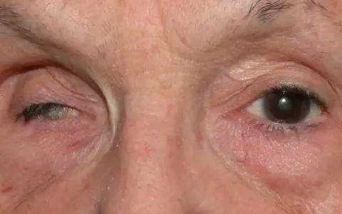 Primo piano degli occhi di una persona. L'occhio sinistro mostra segni di atrofia oculare, con la palpebra abbassata. L'occhio destro appare normale.