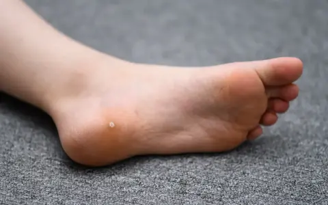 Verrue sur le talon d'un pied. Des avis sur le tea tree pour traiter cette verrue sont recherchés.