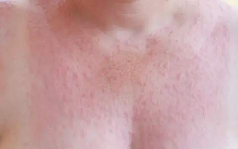 Hudutslag på bröstet, troligen soleksem. Kan behöva soleksem allergitabletter för lindring.