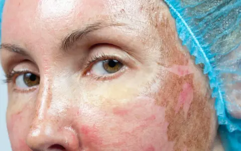 Skóra po zabiegu: peeling chemiczny na przebarwienia. Widoczne zaczerwienienie i złuszczanie naskórka.
