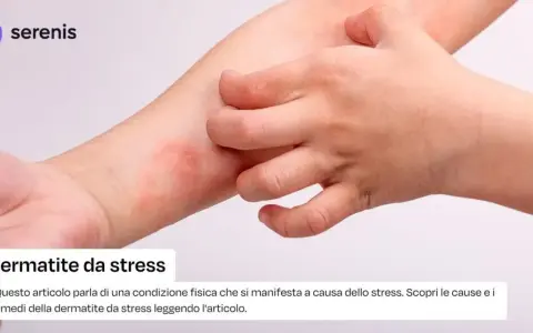 Braccio con arrossamento e sfogo cutaneo, un dito che si gratta. Potrebbe essere dermatite da stress senza prurito.