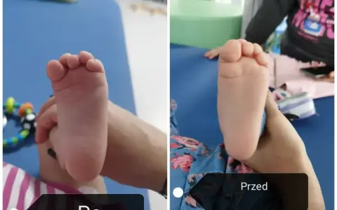 Dwie stopy dziecka, jedna po drugiej. Widać postęp w leczeniu szpotawych stóp.