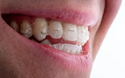 Uśmiech z niewidocznymi nakładkami Invisalign Comprehensive, które delikatnie korygują zgryz.