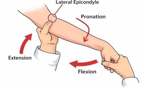 Illustration zeigt einen Tennisarm Test. Der Arzt drückt auf den lateralen Epikondylus, während er Extension und Pronation des Arms ausführt.