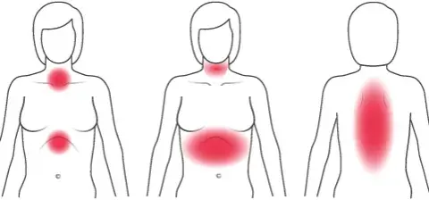 Herzinfarkt Frauen Symptome: Unterschätzte Anzeichen rechtzeitig erkennen