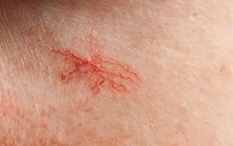 Widoczne popękane naczynka na piersiach, tworzące delikatną, czerwoną pajęczynkę na jasnej skórze.