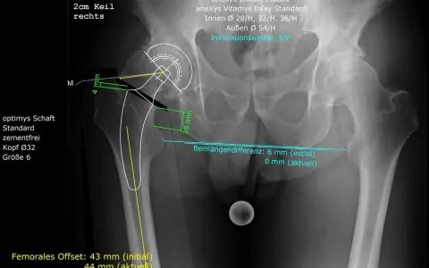Röntgenbild des rechten Hüftgelenks mit Markierungen zur Beurteilung der coxarthrose stadien und der Beinlänge.