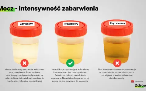 Kolor moczu co oznacza? Jasny, prawidłowy i ciemny mocz w pojemnikach. Jasny może oznaczać przewodnienie, prawidłowy zdrowie, a ciemny odwodnienie.