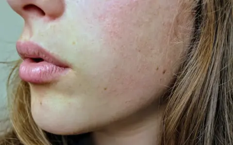 Primer plano de la piel de una mujer con poros obstruidos, pecas y labios rosados.