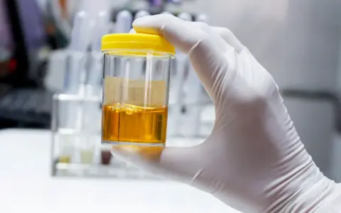 Rękawiczka trzyma pojemnik z żółtym płynem. Wynik badania: leukocyty w moczu 100/ul.