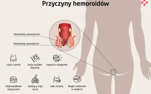 Ilustracja pokazuje przyczyny hemoroidów, w tym ciążę, wysiłek fizyczny, zaparcia, nieprawidłowe odżywianie, siedzący tryb życia i seks analny. Czy hemoroidy są groźne?