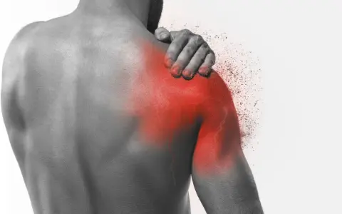 Ból barku, objaw capsulitis adhesiva, zaznaczony czerwienią.
