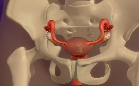 Anatomical model showing the female reproductive system within the pelvis. The uterus has undergone usunięcie macicy, with sutures visible at the cervical stump.