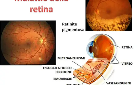 Immagini di malattie retiniche, tra cui la retinite pigmentosa e la retinopatia diabetica, che mostrano difetti dell'epitelio pigmentato retinico, emorragie e vasi sanguigni alterati.