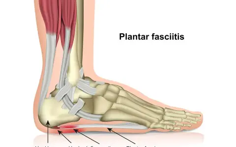 Anatomische Darstellung des Fußes, die zeigt, wie die Plantarfasziitis immer schlimmer wird, mit Entzündung an der Ferse.