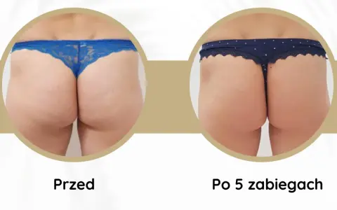 Widoczne **efekty endermologii po 6 zabiegach** na pośladkach. Skóra jest gładsza, bardziej jędrna i napięta.