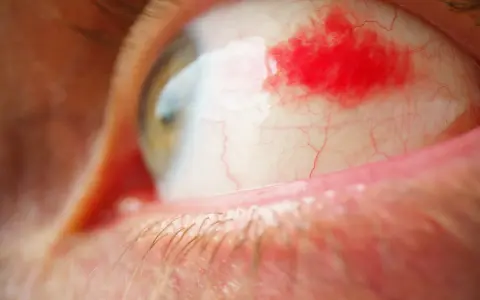 Un occhio umano con la sclera arrossata e una macchia di sangue visibile. Le ciglia sono sfocate in primo piano, mentre l'iride verde-marrone è parzialmente visibile.