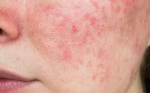 Primo piano del viso con evidenti rossori e imperfezioni cutanee, che suggeriscono una condizione come la rosacea o l'acne.
