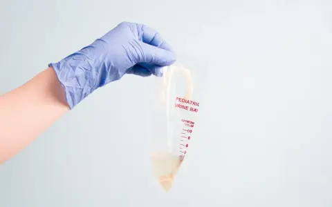 Ręka w niebieskiej rękawiczce trzyma woreczek na mocz dla dziewczynki. Woreczek jest przezroczysty, z podziałką i napisem "Pediatric Urine Bag".