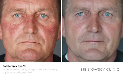 Przed i po fototerapii Dye-VI: widoczna poprawa rumienia i zmian naczyniowych, skuteczna w leczeniu trądziku różowatego u mężczyzn.