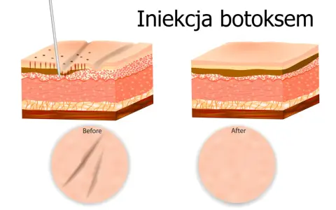 Ilustracja pokazuje iniekcję botoksu, która wygładza zmarszczki. Zastanawiasz się, ktory botox jest najlepszy?