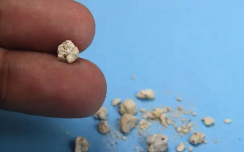 Palec trzyma niewielki kamyk, jeden z wielu złogów w nerkach 4mm, które wypadły.