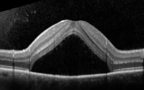 OCT di occhio con corioretinopatia sierosa centrale. Evitare stress e cortisone per non peggiorare la condizione.