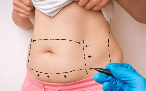 Liposukcja: Odkryj prawdę o odsysaniu tłuszczu. Co musisz wiedzieć?