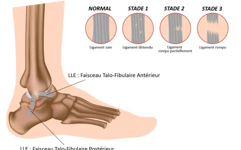 Illustration des différents stades d'une entorse du pied, du ligament sain au ligament rompu.