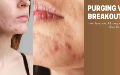 Close-up of a face with acne, showing breakouts after starting a new skincare routine. Text reads "PURGING VS. BREAKOUTS: Identifying and Managing Your Skin's Response.