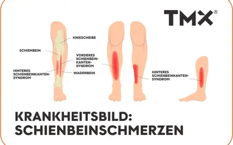 Illustrationen zeigen verschiedene Ursachen für starke Schmerzen im Schienbein im Ruhezustand, wie das vordere und hintere Schienbeinkantensyndrom.
