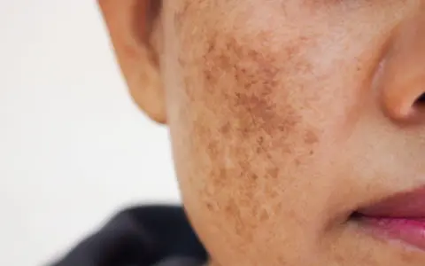 Gros plan sur une joue montrant une tache brune sur la peau, résultat d'une hyperpigmentation.