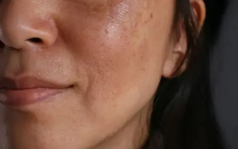 Primo piano del viso di una donna con evidenti macchie solari e discromie sulla pelle.