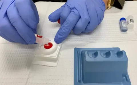 Manos enguantadas realizan prueba rápida para diagnóstico y tratamiento de gonorrea.