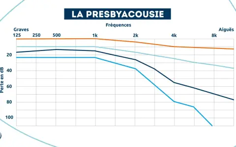 Graphique montrant la perte auditive en décibels selon l'âge et la fréquence. À partir de 20 dB, on entend moins bien.